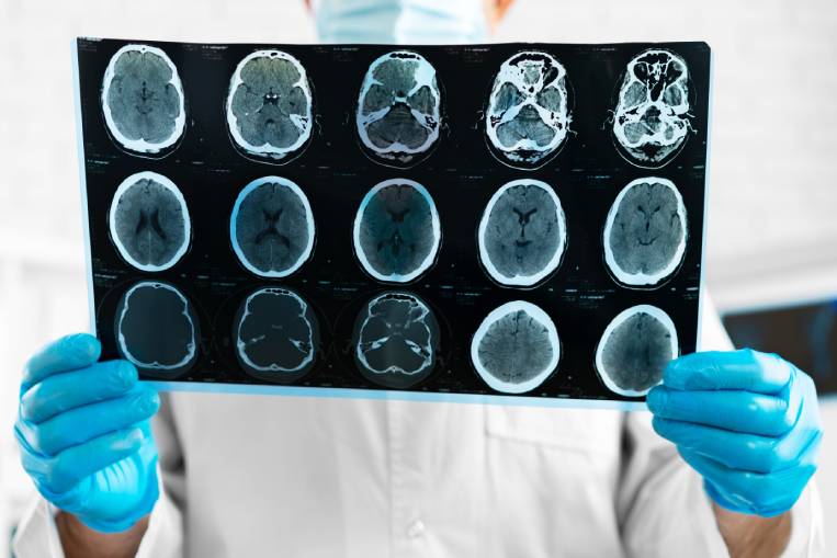 defensa legal en casos de lesiones cerebrales traumaticas